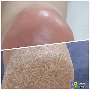 ناخن سایه