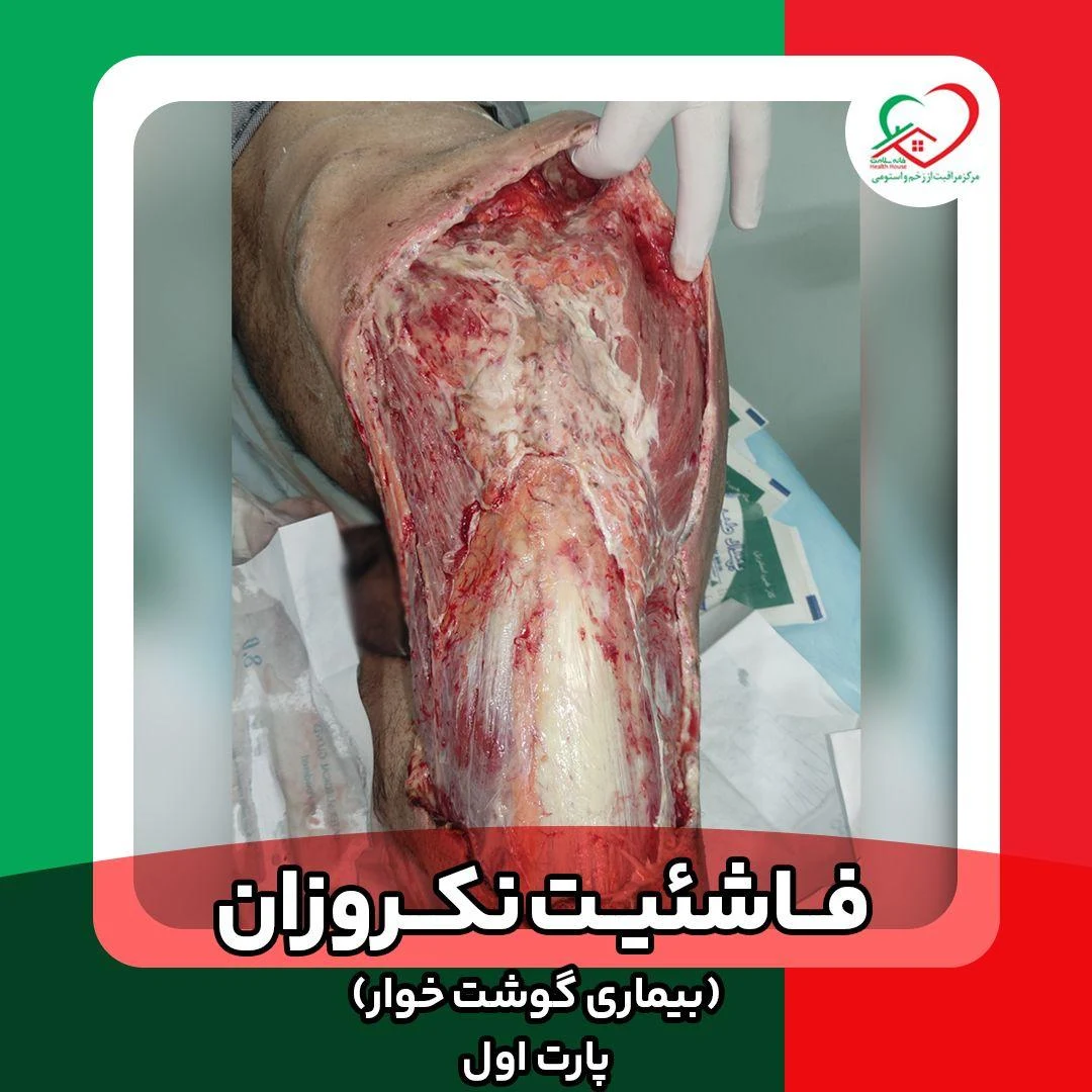 مرکز تخصصی درمان زخم تندیس تندرستی - خدمات پرستاری در منزل در مشهد - تصویر 4