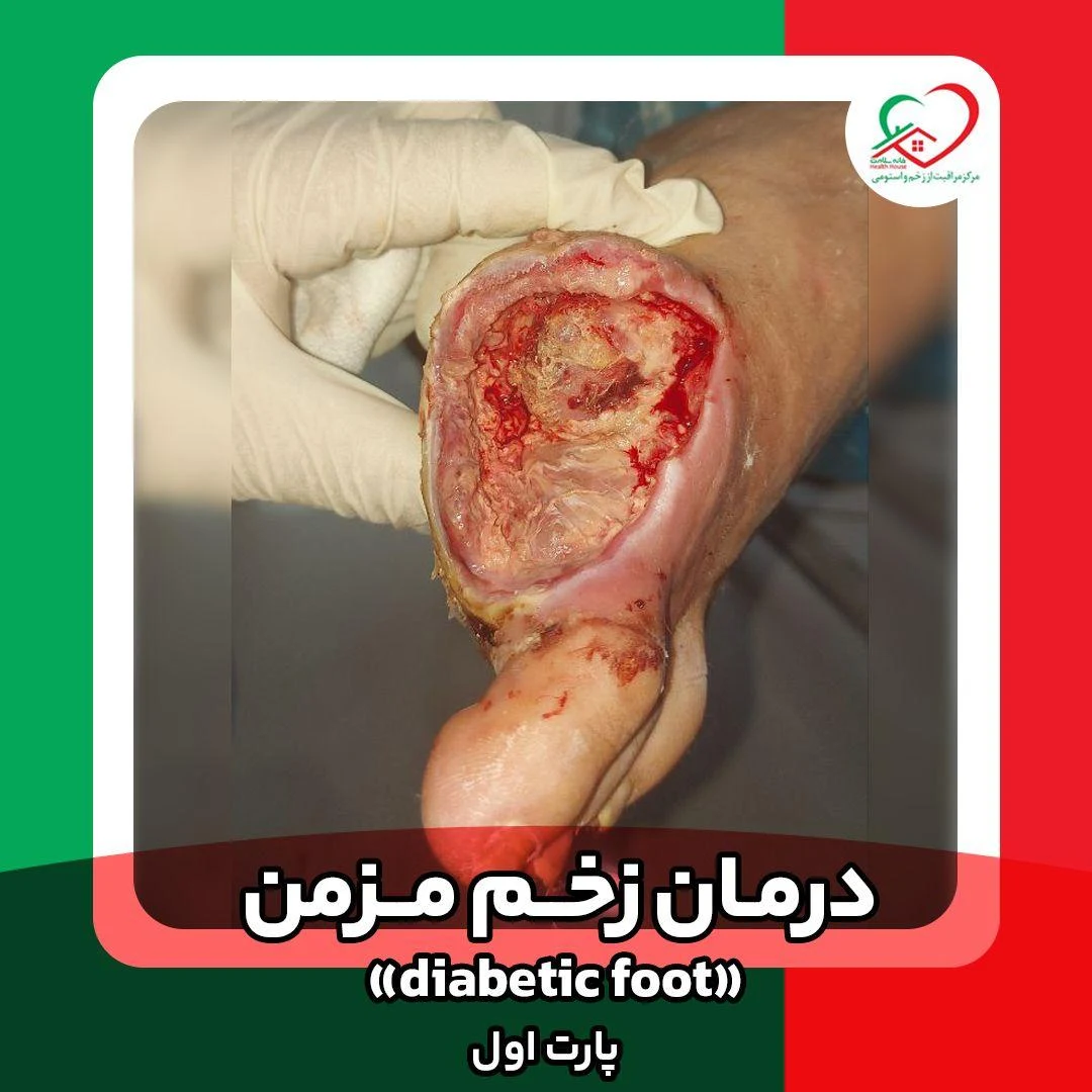 مرکز تخصصی درمان زخم تندیس تندرستی - خدمات پرستاری در منزل در مشهد - تصویر 5