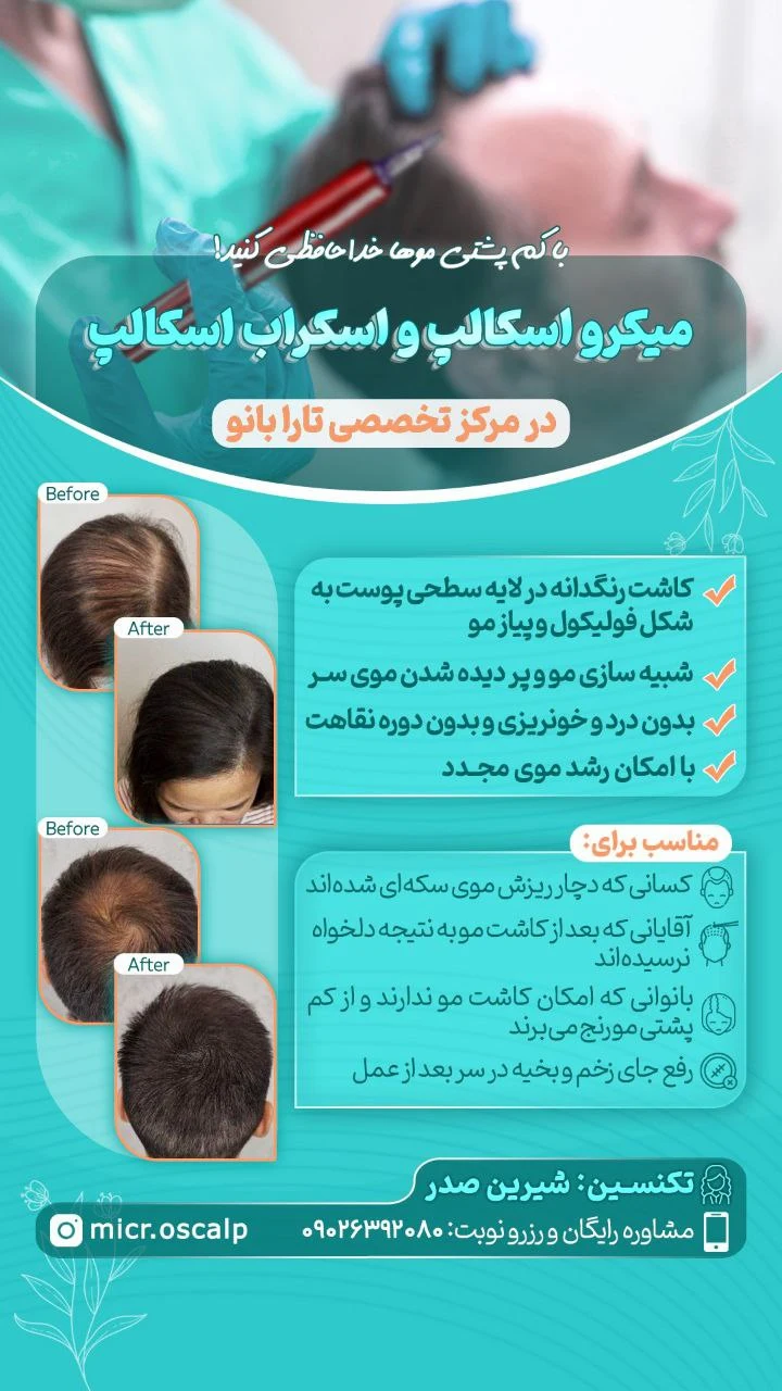 میکرو اسکالپ صدر