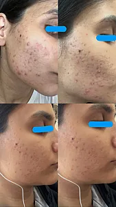 پاکسازی پوست و فیشیال طهورا (پنس بیوتی)