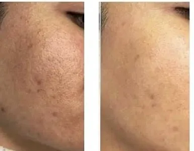 پاکسازی تخصصی پوست تارا ( فیشال تخصصی)